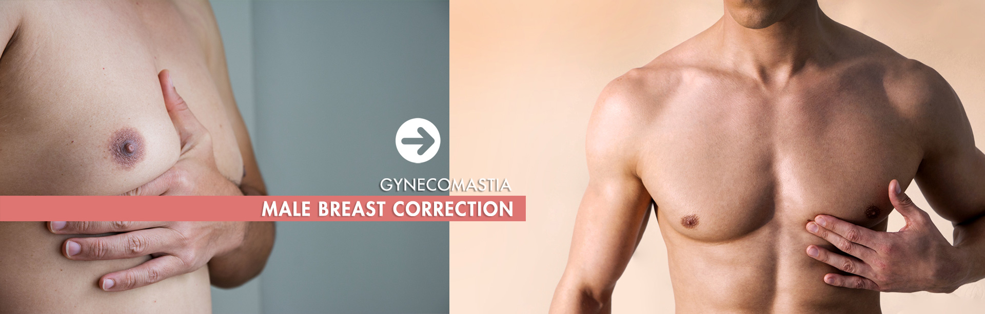 Male Breast Correction Hyderabad