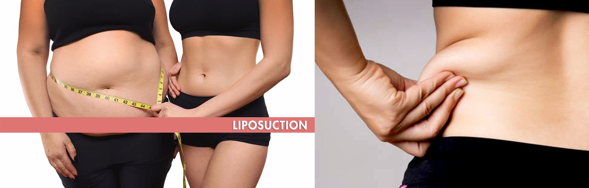 Liposuction Hyderabad