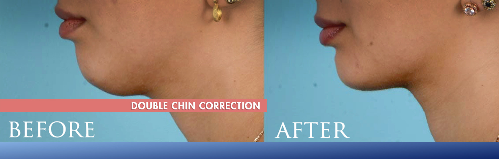 Double chin surgery hyderabad