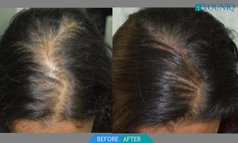 Female Hair Transplant | Hair Transplant in womens in Hyderabad, India