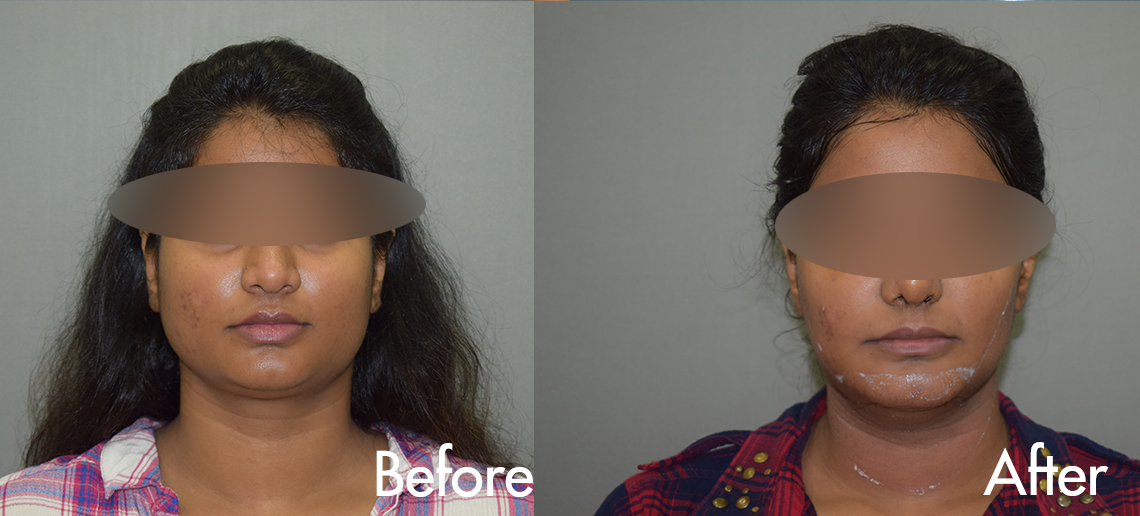 Female Double Chin Correction Treatment in Hyderabad, India