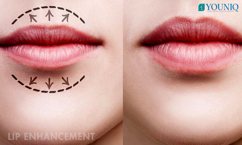 lip enhancement surgery hyderabad