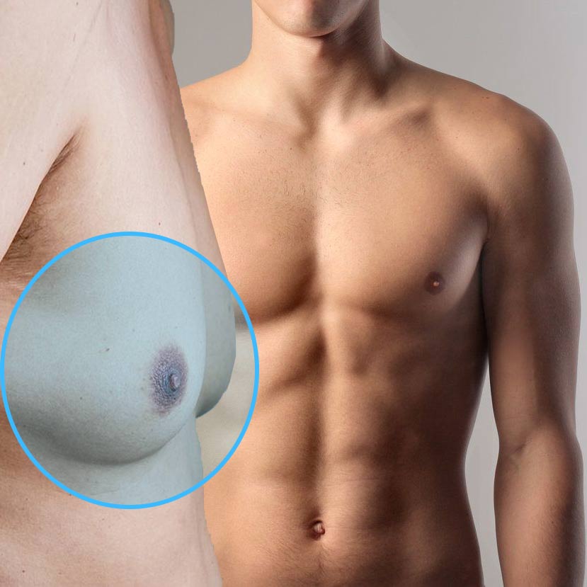 Male Breast Reduction Surgery in Hyderabad, India