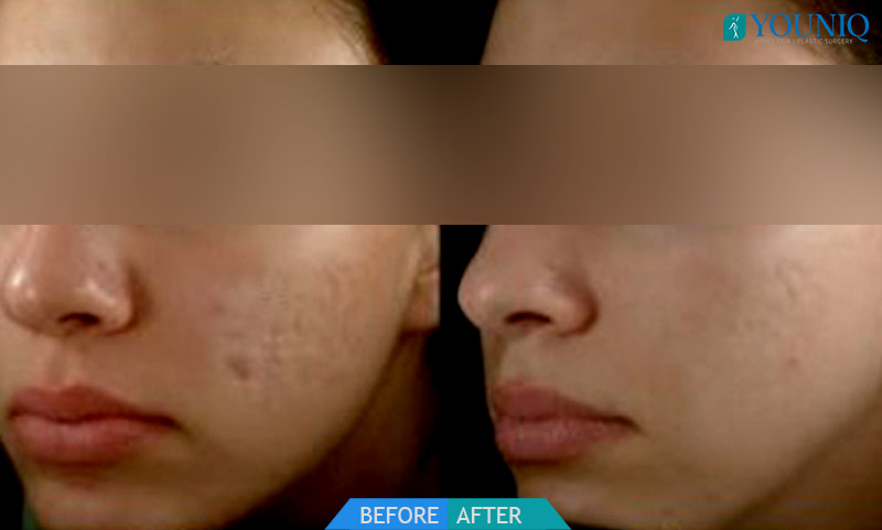 laser acne treatment hyderabad