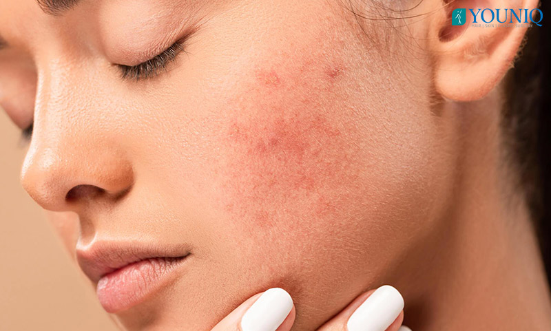 Laser Acne Treatment in Hyderabad