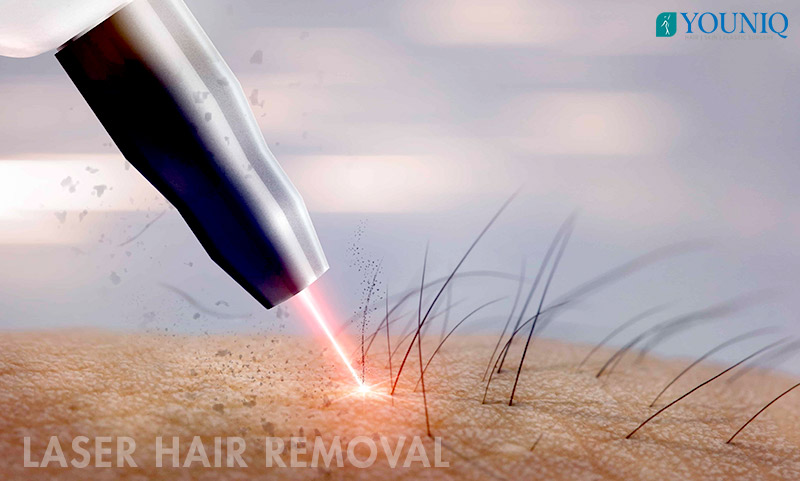 Laser Hair Removal Treatment in Hyderabad, India
