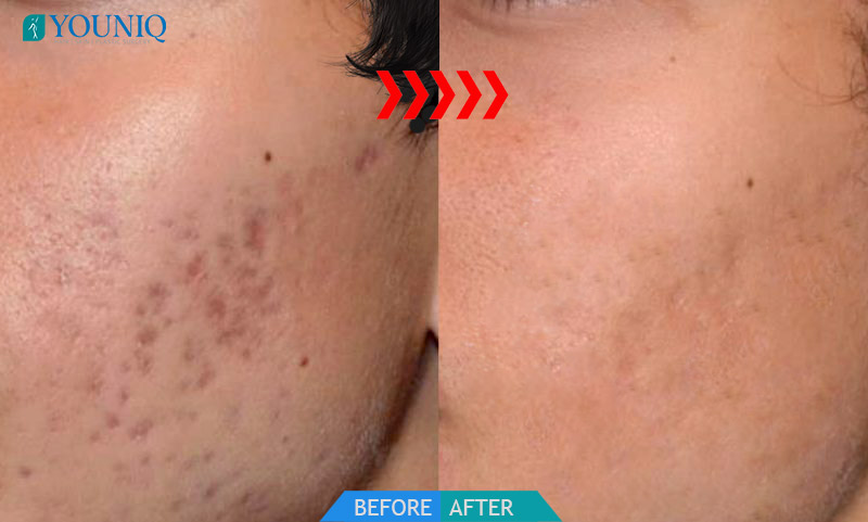 laser enlarged pores Hyderabad - BEFORE AFTER 1