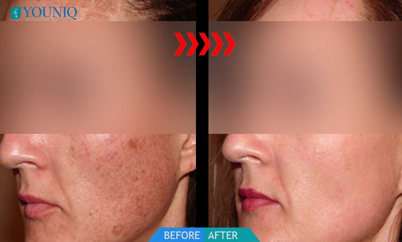 laser enlarged pores Hyderabad - BEFORE AFTER 1