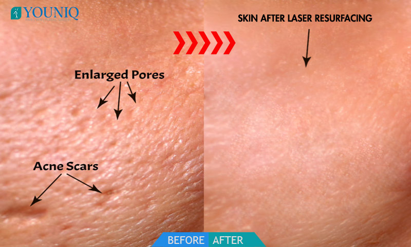 Laser Enlarged Pores Treatment in Hyderabad