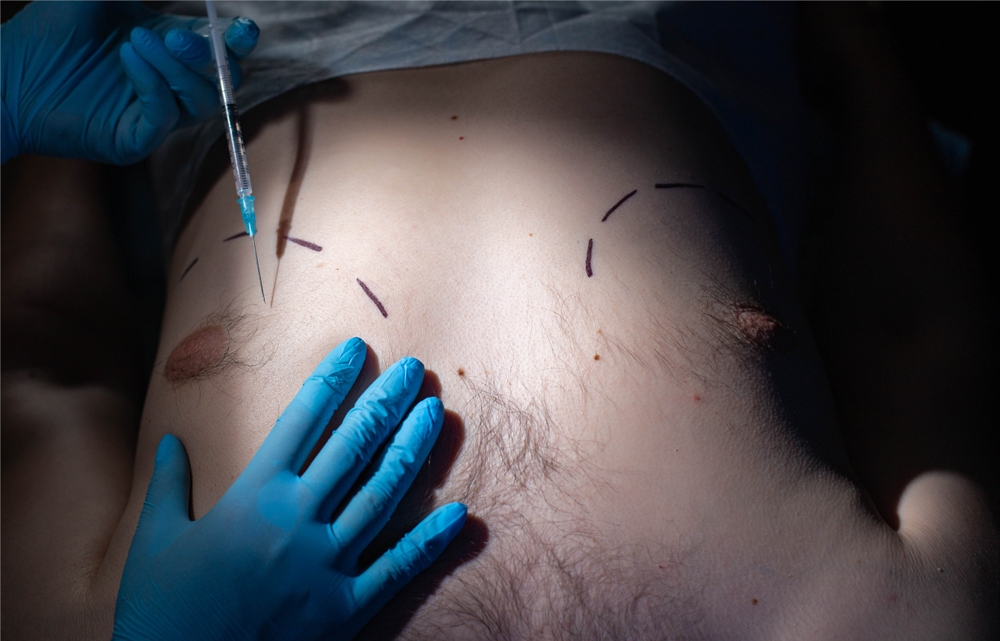 Male Breast Reduction Treatment in hyderabad