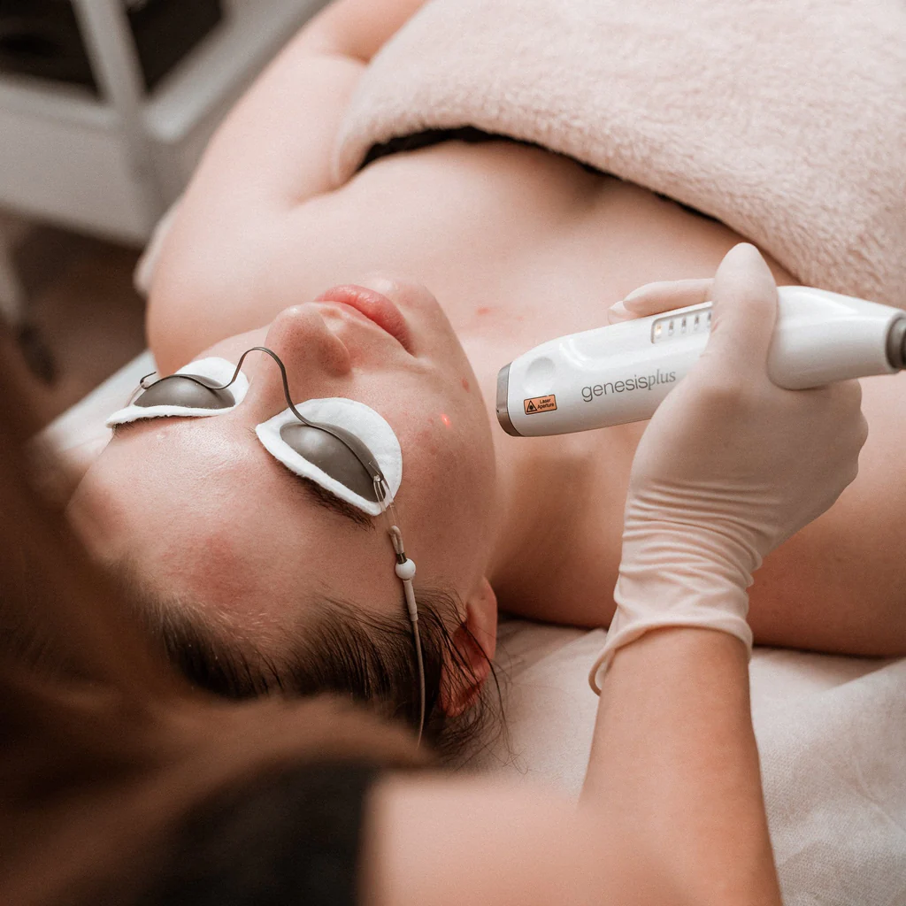 Non-invasive laser treatment in Hyderabad to reduce enlarged pores for smoother skin.
