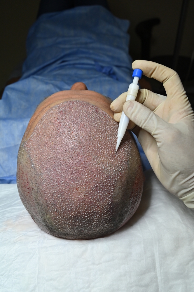 Hair Transplantation in jubilee hills Hyderabad