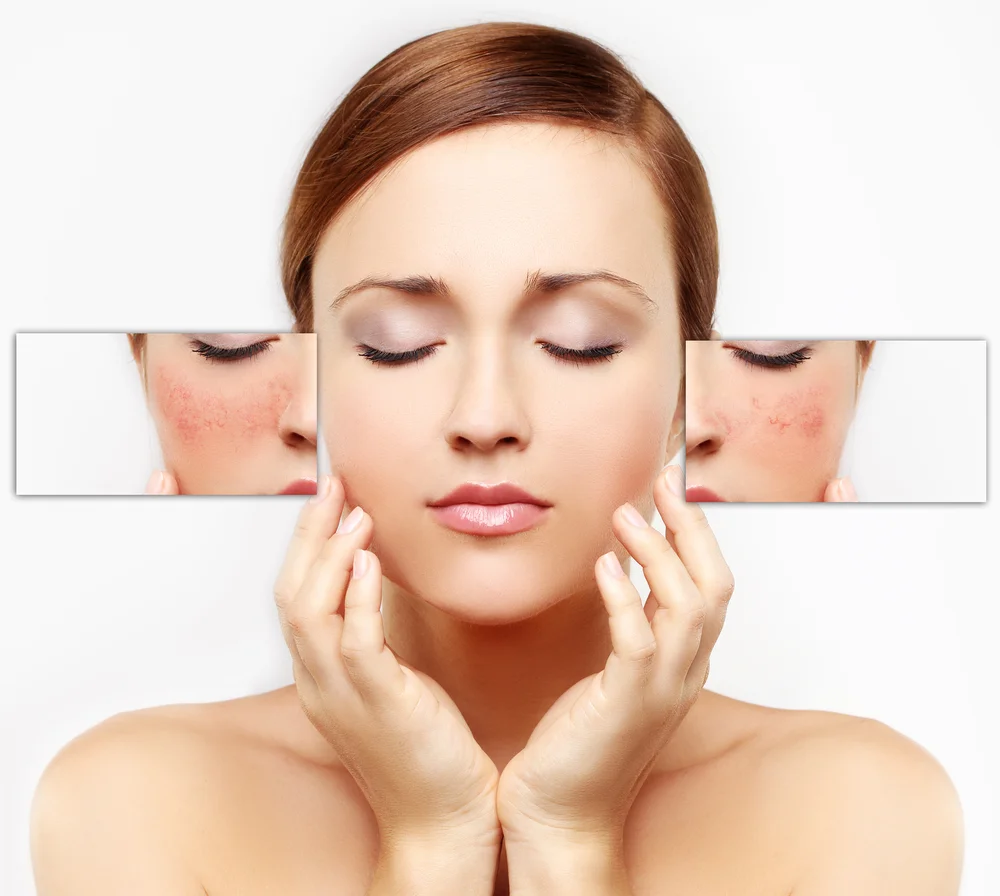Effective laser pigmentation removal to reduce dark spots and uneven skin tone.