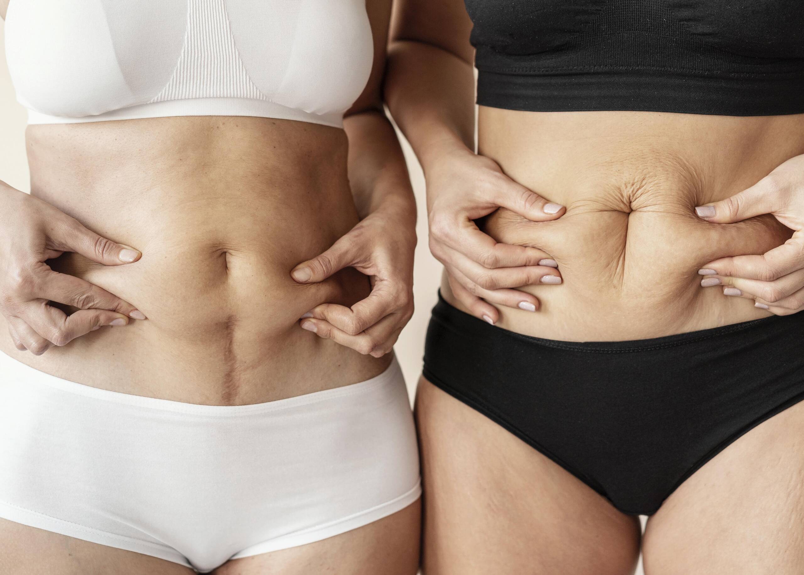 Best lipo surgery in Hyderabad with advanced techniques and personalized care by top cosmetic surgeons.