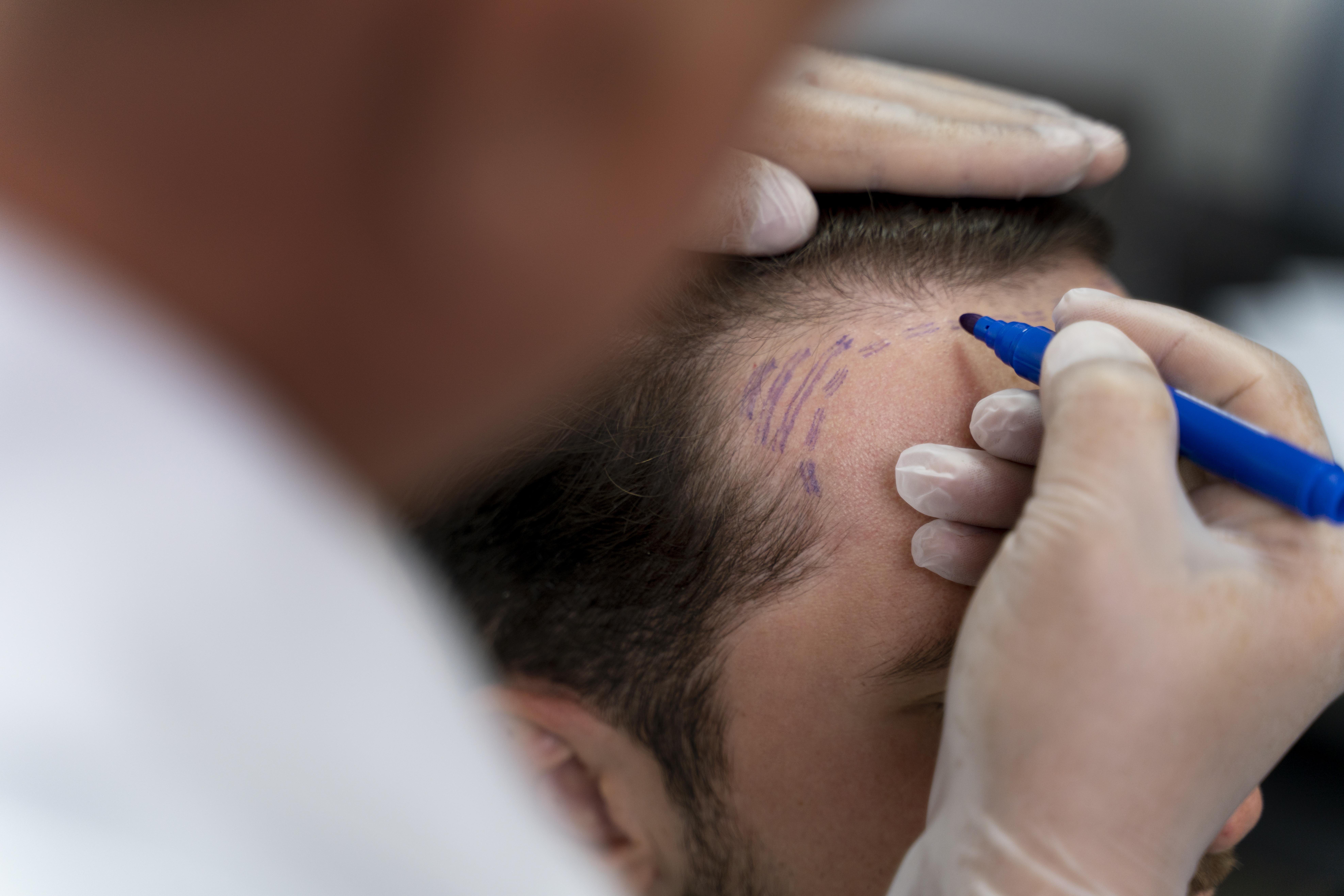 Hair Transplantation : A Permanent Solution for Hair Loss